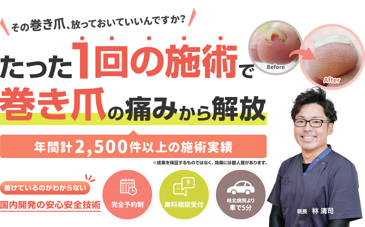 たった1回の施術で巻き爪の痛みから解放
