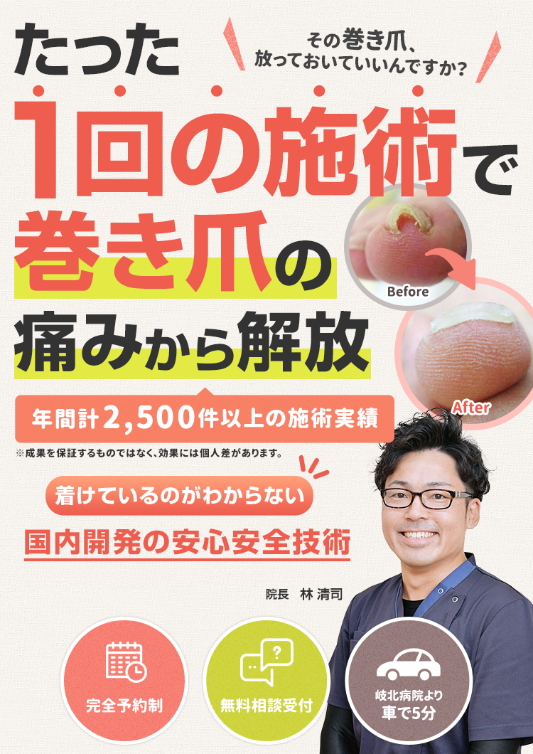 たった1回の施術で巻き爪の痛みから解放